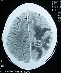 CT brain tumor.jpg
