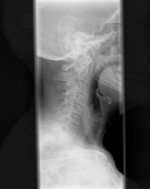 Xray of cervical spine