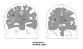 A scan of a brain on the Mediterranean diet (left) showing the effects of a vegetable based diet on the ventricles, white matter, and mass of the brain versus a scan of a normal brain (right).]]