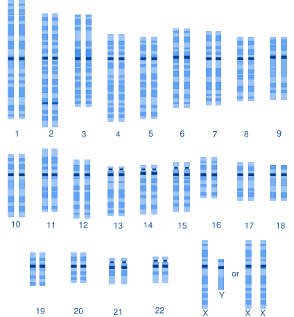 karyotype of hemophilia. karyotype of hemophilia.