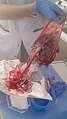 Després del part: Placenta amb la bossa amniòtica unida