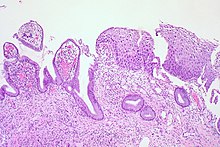 LSIL (CIN 1), Cervical Biopsy (3776284166).jpg