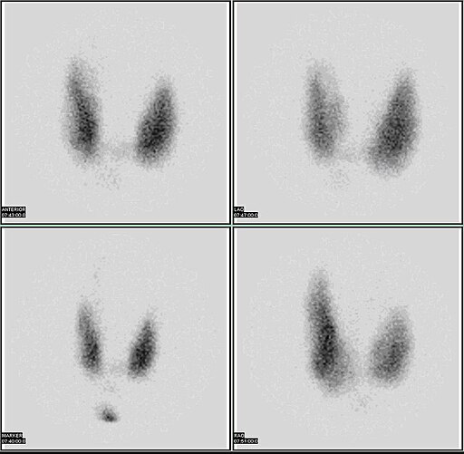 Thyroid scan