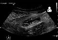 Ultrasound showing appendicitis and an appendicolith[50]