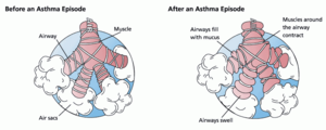 Asthma before-after