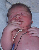 Cyanotic neonate.jpg