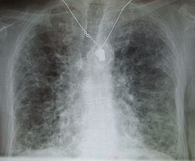 A chest X-ray demonstrating pulmonary fibrosis. By history, the pulmonary fibrosis is thought to be due to amiodarone.