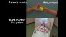 Файл: Induced-sensorimotor-brain-plasticity-controls-pain-in-phantom-limb-пациенты-ncomms13209-s2.ogv