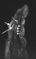 Magnetic resonance image of the index finger in psoriatic arthritis (mutilans form). Shown is a T2 weighted fat suppressed sagittal image. Focal increased signal (probable erosion) is seen at the base of the middle phalanx (long thin arrow). There is synovitis at the proximal interphalangeal joint (long thick arrow) plus increased signal in the overlying soft tissues indicating edema (short thick arrow). There is also diffuse bone edema (short thin arrows) involving the head of the proximal phalanx and extending distally down the shaft.