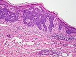 SkinTumors-P6160271.JPG