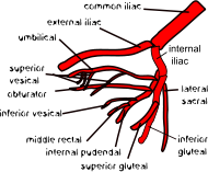 One variation of internal iliac artery branching (4 more versions not shown here)