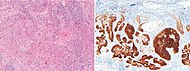 BCC с плоскоклетъчна метаплазия с оцветяване с HE и BerEP4.jpg