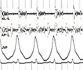 Miniatura per Fonocardiograma