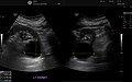 Renal cyst as seen on abdominal ultrasound