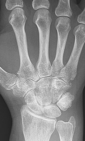 Rheumatoid arthritis with unaffected carpal bones 2009.jpg