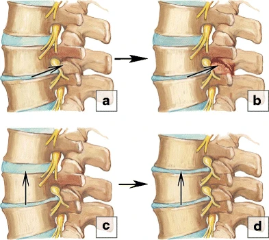 File:Types of spinal degeneration.webp