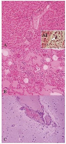 Weissella confusa у зразку тканин мавпи (забарвлення гематоксиліні та еозином): A) печінка, B) гостра пневмонія, C) енцефаліт