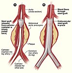 En stent placeras på plats och expanderas med blåsan.