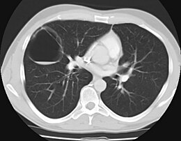 Description de l'image Computerized tomography of the chest of a patient with congenital cystic adenomatoid malformation.jpg.