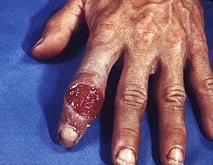 Primary chancre of syphilis on the hand. Unlik...