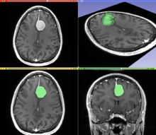 A T1 weighted MR image of the brain of a patient with a meningioma after injection of an MRI contrast agent (top left), and the same image with the result of an interactive segmentation overlaid in green (3D model of the segmentation on the top right, axial and coronal views at the bottom). MeningiomaMRISegmentation.png