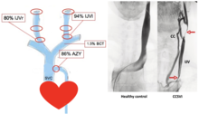 stenosi ccsvi