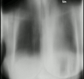 Tomosynthesis of chronic fibrosing pulmonary aspergillosis Tomosynthesis of chronic fibrosing pulmonary aspergillosis.gif