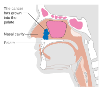 Diagram showing stage T3 cancer of the nasal cavity