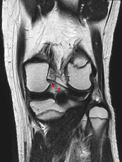 Posterior meniscofemoral ligament on MRI, coronal