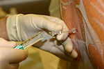Miniatura para Anestesia intradural
