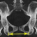 Intertuberous diameter, as a measure of the transverse measure of the pelvic outlet