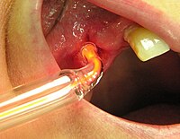 Ozone therapy as a dental procedure Ozone for dental application.jpg