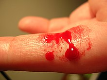 Bleeding finger.jpg