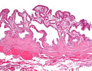 Gallbladder cholesterolosis low mag.jpg