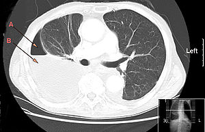 Hydro pneumothorax.jpg