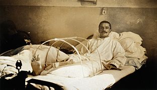 Soldado ferido em Verdun e amputado da perna no hospital militar em Ris-Orangis. 1916.