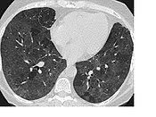 CT image showing mosaic attenuation pattern in patient with hypersensitivity pneumonitis. Note the alternating, patchy areas of increased and decreased attenuation, particularly in the left lung (screen right).