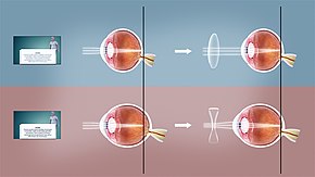 Top: farsighted corrected using convex lens Bottom: nearsighted corrected using concave lens. Refractive error.jpg
