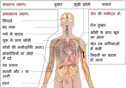 कोभिड-१९ का लक्षण। लक्षण नभया व्यक्तिअनले साद्दु सक्क्या केही प्रतिवेदनले बताउँछ।[७]