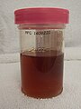 Dark red urine due to blood (hematuria).