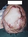 Rezidiv sechs Wochen nach der Tumorresektion. Um den transplantierten Hautlappen sind mehrere Satellitenmetastasen erkennbar.