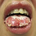 Mucosal desquamation in a person with Stevens–Johnson syndrome