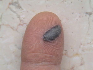 Blood blister on 1st finger of left hand. This...