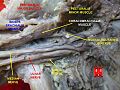 Radial nerve at newborn