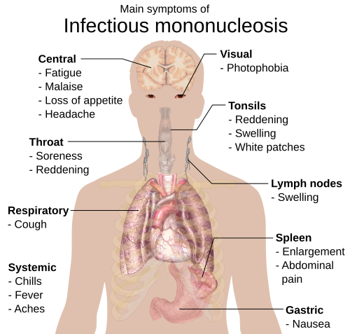 500px-Main_symptoms_of_Infectious_mononucleosis.svg.png