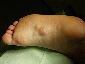 Fibromatosi plantar