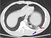 A CT scan showing a pulmonary contusion (red arrow)