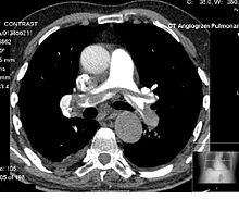 A CT pulmonary angiogram image generated by a computer from a collection of x-rays SADDLE PE.JPG