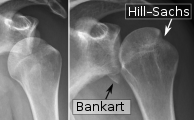 Röntgenfoto van een schoudergewricht met een bankartlaesie en hill-sachslaesie