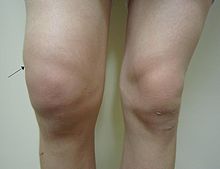 Fluid In Knee